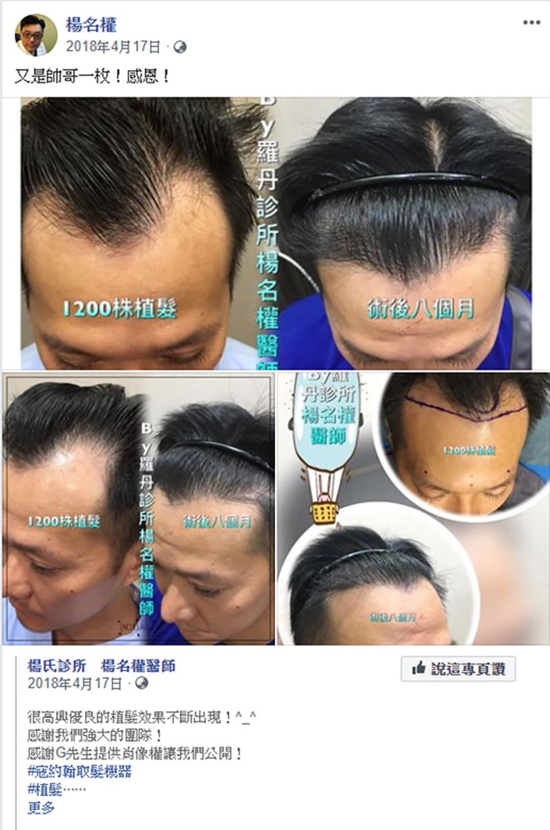 生髮613 植髮,ARTAS,機器系統植髮,楊名權